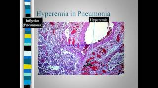 Pathology of congestion Vs Hyperemia [upl. by Schenck]