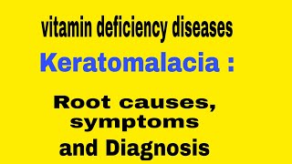 Keratomalacia Vitamin deficiency diseases [upl. by Silvan]