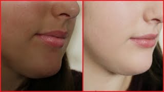 How To Remove Hyperpigmentation Darkness Dark Patches Dark Spots amp Darkness Around Mouth [upl. by Fesoj]