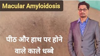 पीठ और हाथ पर होने वाले काले धब्बे  Macular Amyloidosis  Black Spots on Back and Arm pigmentation [upl. by Meg]