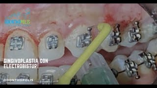 Gingivoplastia Con ElectroBisturí [upl. by Corson]