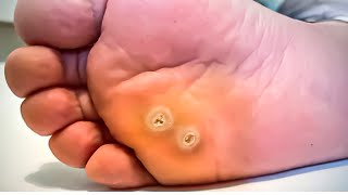 How To Remove a Foot Corn or Callus Foot Doctor Home Treatment [upl. by Ole]