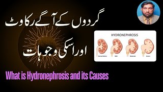 What is Hydronephrosis and its Causes [upl. by Sidnal]