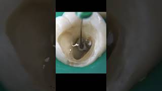 Bastidores da Odontologia  Tratamento de Canal 🦷 [upl. by Adiene]