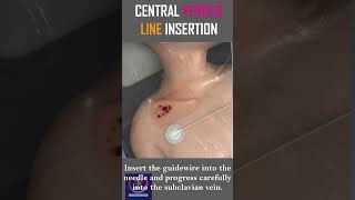 Central Venous Line Insertion  Step By Step Procedure  shorts [upl. by Pius]