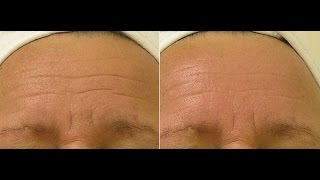 Hydra Facial Before amp After Gallery  Photos of Facial amp Body Skin Treatment in Princeton NJ [upl. by Lemmuela]