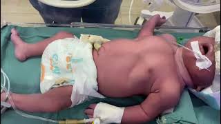 baby at NICU  subcostal retraction on CPAP drtmam [upl. by Suiraj]