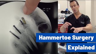 Hammertoe Correction Surgery Explained by Dr Moore  Using the Phalinx Hammertoe Fixation System [upl. by Atokad]