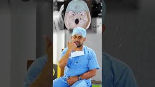 CSF RHINORRHEA in HEAD INJURED patients How to Treat it Dr Prabhu M in Tamil Short 1 [upl. by Nettirb]