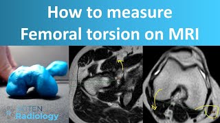 How to measure femoral torsion on MRI [upl. by Cynthia383]