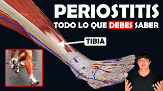 PERIOSTITIS TIBIAL Su TRATAMIENTO y lo que debes saber [upl. by Lareine]