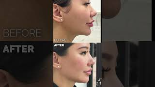 Jaw enhancement with filler with Jonathon [upl. by Aylatan]