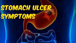 Stomach Ulcer Symptoms What Are the Warning Signs of an Ulcer [upl. by Nnoryt]