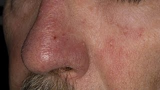 How to Treat Eczema on Face  Seborrheic Dermatitis Treatment  Face Eczema Treatment [upl. by Irual953]