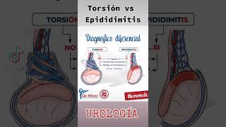 Torsión Testicular vs Epididimitis Urología Medicina Resúmenes Tips [upl. by Oderfliw]