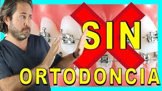 🔷Dientes 𝐓𝐎𝐑𝐂𝐈𝐃𝐎𝐒 𝐒𝐎𝐋𝐔𝐂𝐈𝐎𝐍 sin BRACKETS👍 Como tener los DIENTES RECTOS sin APARATO [upl. by Hut]