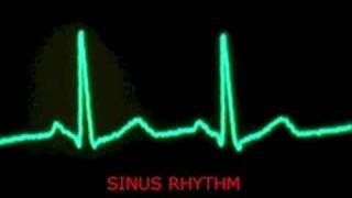 audible heart beat  extrasystoles  PVC and sinus beats [upl. by Adam277]