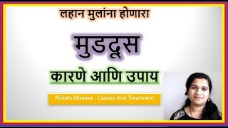 लहान मुलांना होणारा मुडदूस कारणे आणि उपाय  Rickets In Babies  Causes and Treatment [upl. by Harahs]