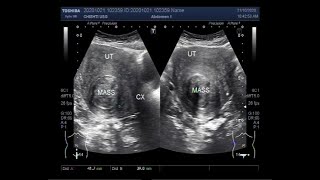 Ultrasound Video showing Two videos of Fibroids Uterus [upl. by Phippen]