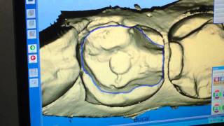 Diseño de incrustación en sistema CADCAM Cerec Godín Odontolgía Cali valle [upl. by Clapp]