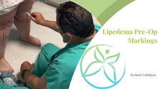 Preoperative Markings for Lipedema Liposuction  Lower Extremities  Dr Boris Volshteyn [upl. by Reilly441]