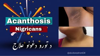 Acanthosis Nigricans Treatment  hyperpigmentation [upl. by Juliann]