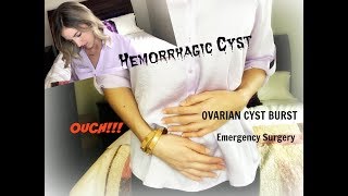 Girl Talk My Ovarian Cyst Story [upl. by Cicely482]