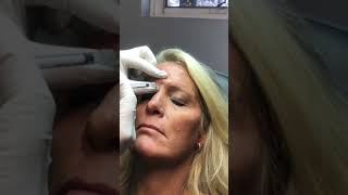 Dr Gina Mantor injecting Botox in the 11’s or GlabellaFrown lines [upl. by Sheridan]