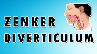 Zenkers Diverticulum [upl. by Nitsu210]