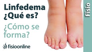 Linfa edema o linfedema  Qué es y cómo se forma [upl. by Buchheim]