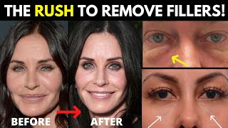 The 2022 Filler Trend Why is everyone all of a sudden dissolving their fillers [upl. by Kayle]