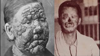 The TERRIFIC History of Leprosy [upl. by Ynnaj]