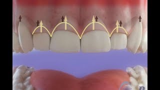 खराब होते मसूढ़ों का उपचार Gingivectomy © [upl. by Aihsekin]