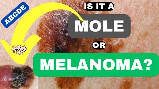 ABCDE of Melanoma Is it a Mole or Melanoma  ABCDE of Skin Cancer  Skin Cancer Symptoms and Signs [upl. by Crosley346]