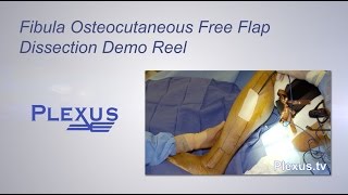 Fibula Osteocutaneous Free Flap Dissection Video [upl. by Sudbury511]