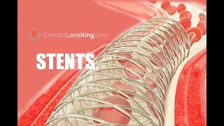 What are Stents How Do Stents Work How are Stents Inserted [upl. by Edyth]