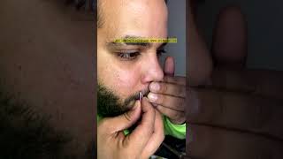 Big Cystic Acne Large Blackheads Extraction Blackheads Whiteheads Removal Pimple Popping P06 Shorts [upl. by Otreblasiul]