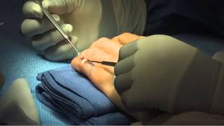 Treatment of Chronic Mallet Finger by Leo Rozmaryn MD [upl. by Lzeil580]