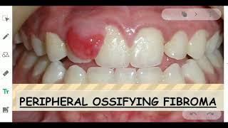 PERIPHERAL OSSIFYING FIBROMA  ORAL PATHOLOGY [upl. by Sherm486]