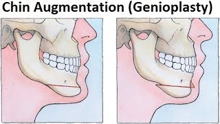 Treatment of Retruded JawsMandible Using GenioplastyMentoplastyChin Augmentation by Dr Mike Mew [upl. by Tay192]