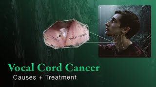 Early Vocal Cord Cancer  Introduction and Treatment Options [upl. by Aihsital]