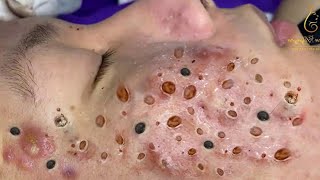 Blackhead Removal With Sac Dep Spa 1000617 [upl. by Masuh]