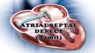 ATRIAL SEPTAL DEFECT ASDTAMIL  TYPES  HEMODYNAMICS HEART SOUND  ASD INVESTIGATION MANAGEMENT [upl. by Ij]