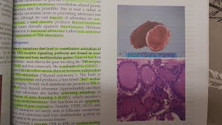 Thyroid Adenoma  SPECIAL PATHOLOGY [upl. by Hasan]