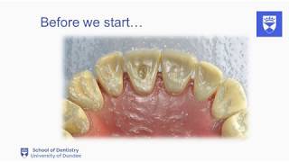 Endodontic treatment of the single rooted tooth Part 2 Access cavity preparation [upl. by Giliane736]