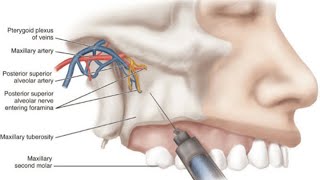 المحاضرة الثامنة  الجزء الاول  LOCAL ANESTHESIA6 “Basic Techniques of Dental Local Anesthesia” [upl. by Auj]