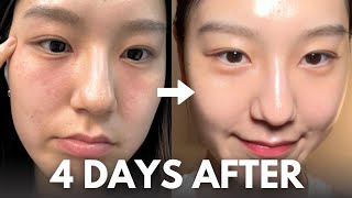 How I repair my skin barrier in 4 days at home with affordable skincare routine [upl. by Thera]