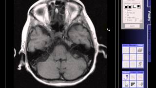 BRAIN MRI OLD INFARCTION [upl. by Letnohc]