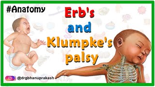 Erbs palsy and klumpkes palsy USMLE Animation  Etiology Clinical features Diagnosis Treatment [upl. by Nnairam386]