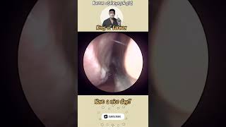 귀지형 콧물 부비동염 축농증 비염 코청소 이비인후과 rhinorrhea rhinitis sinusitis asmr ENT ENTdoctor [upl. by Morgenthaler]